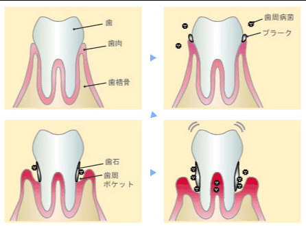 歯周病菌画像 歯周病
