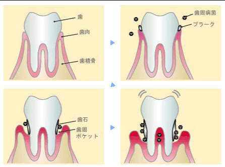 歯周病