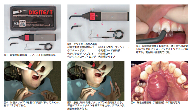 電気歯髄診断器