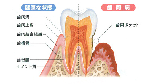 歯周病