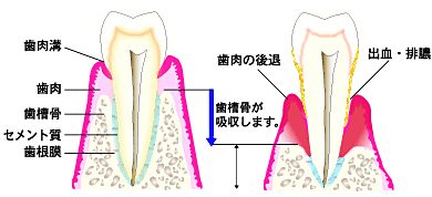 歯周病 歯周病