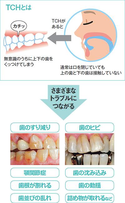 顎関節症患者